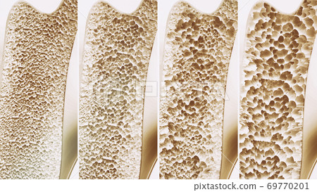 Osteoporosis course in 4 stages 69770201
