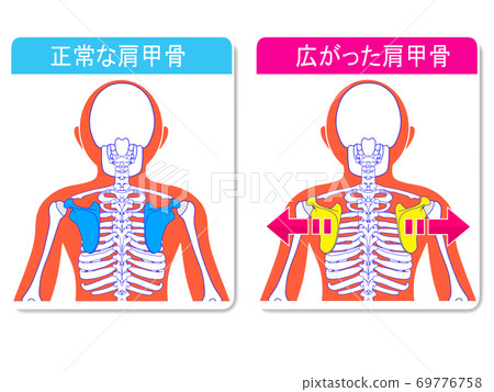 普通肩blade骨和加寬肩shoulder骨 普通肩blade骨和加寬肩shoulder骨 69776758