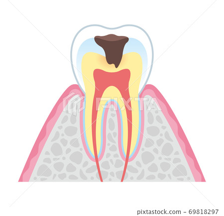 箍牙 牙齒 齒輪 69818297