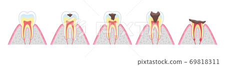 tine, cary, cavity 69818311