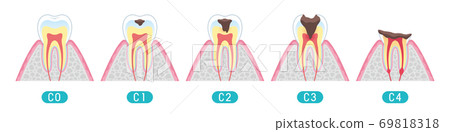 tine, cary, cavity 69818318