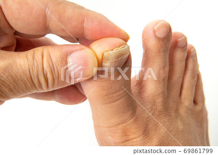 Toenail athlete's foot 69861799