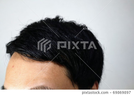 Close-up of a young man suffering from thinning hair 69869897