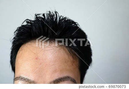 Close-up of a young man suffering from thinning hair 69870073