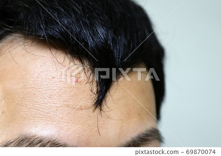 Close-up of a young man suffering from thinning hair 69870074