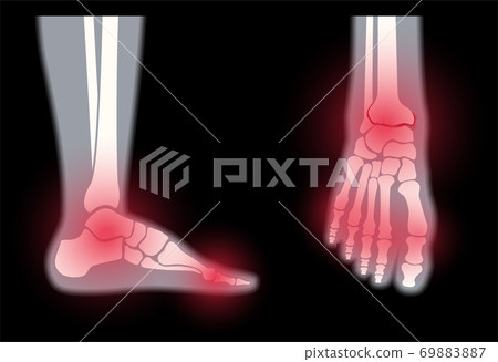 Arthritis foot concept 69883887