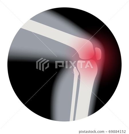 Arthritis in knee joint Arthritis in knee joint 69884152