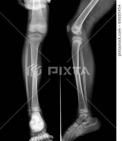 Radiography of Tibial fracture at mid shaft of the bone in young boy patient. Radiography of Tibial fracture at mid shaft of the bone in young boy patient. 69895454