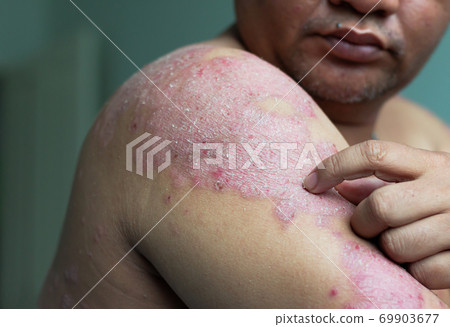 Psoriasis is a skin disease 69903677