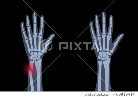 Fracture x ray concept 69919414