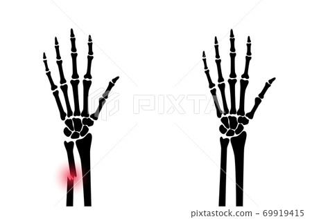 Fracture x ray concept Fracture x ray concept 69919415