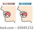 Correct tongue position Wrong tongue position 69945152
