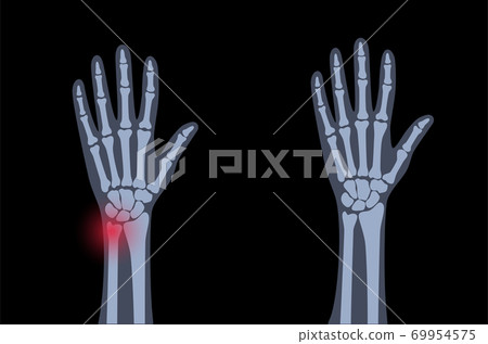 Fracture x ray concept Fracture x ray concept 69954575