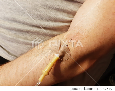 Close-up photo of a male hand with a dropper inserted into a vein 69987649