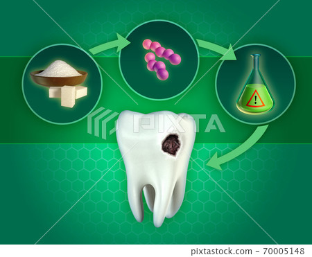 Formation of dental cavities Formation of dental cavities 70005148