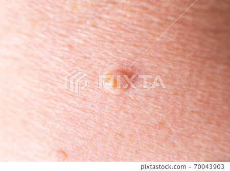 large wart on the skin of a person, background, macro, dermatology 70043903