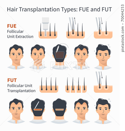Types of hair transplantation FUE and FUT Types of hair transplantation FUE and FUT 70044253