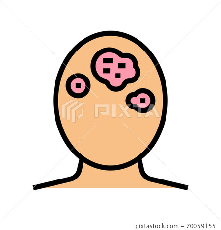 seborrhoeic dermatitis skin disease color icon vector illustration seborrhoeic dermatitis skin disease color icon vector illustration 70059155