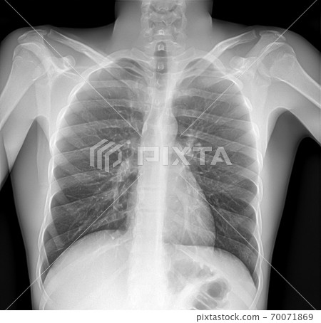 X-ray image of lung with pneumonia X-ray image of lung with pneumonia 70071869