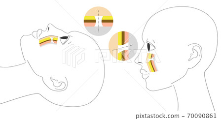 Face lift explanatory diagram Ligament SMAS 70090861