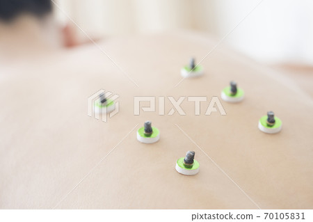 針灸圖片 70105831