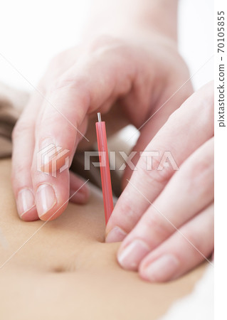 Acupuncture treatment 70105855