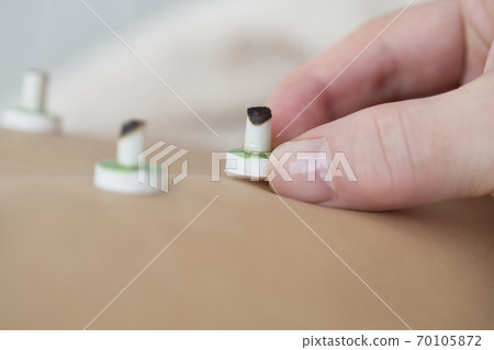 針灸圖片 70105872