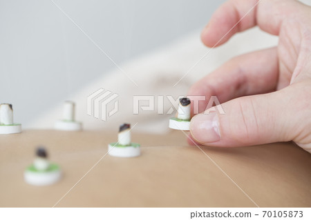 針灸圖片 針灸圖片 70105873