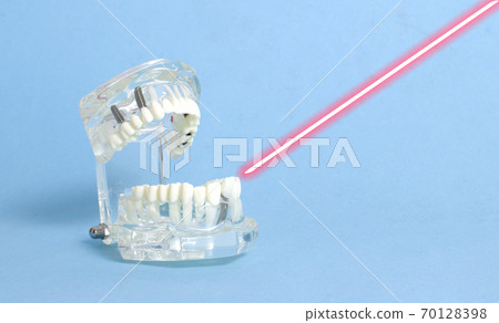 Dental jaw model on blue background with laser. The concept of treatment of caries and pulpitis with a laser device, laser dentistry. Copy space for text 70128398