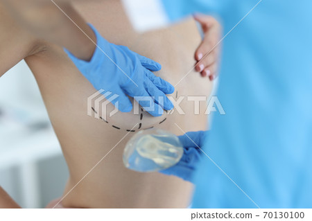 Plastic surgeon's hands are holding breast implant in front of nude patient with lines drawn with marker close-up 70130100