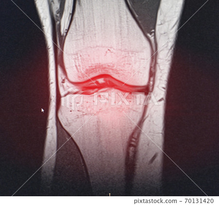 A snapshot of the diagnosis of an MRI of the knee in which arthrosis and arthritis. The concept of joint diagnosis using x-rays, treatment of diseases of the knee joint, bursitis 70131420