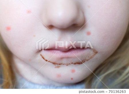 girl s dirty mouth from chocolate and sweets, red pimples on her face. The concept of childhood allergies to sweets, close-up, treatment girl s dirty mouth from chocolate and sweets, red pimples on her face. The concept of childhood allergies to sweets, close-up, treatment 70136263