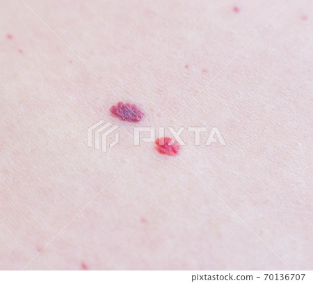 Two red moles on the patient s skin, hemangioma, macro, angioneuromas Two red moles on the patient s skin, hemangioma, macro, angioneuromas 70136707