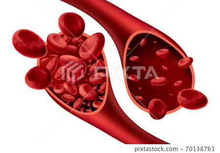 Anemia Anatomy 70138761