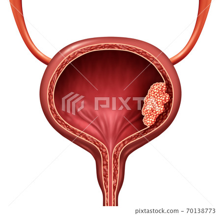 Human Bladder Cancer Human Bladder Cancer 70138773