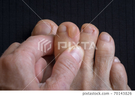big callus on a woman's dirty foot, closeup photo of callus, feet surface injury big callus on a woman's dirty foot, closeup photo of callus, feet surface injury 70143826