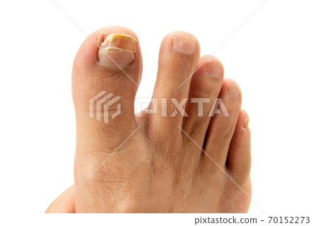 Cracked deals big toe