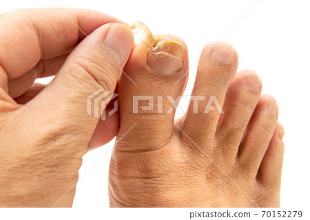 Toenail of a man's big toe cracked by... - Stock Photo [70152279] - PIXTA