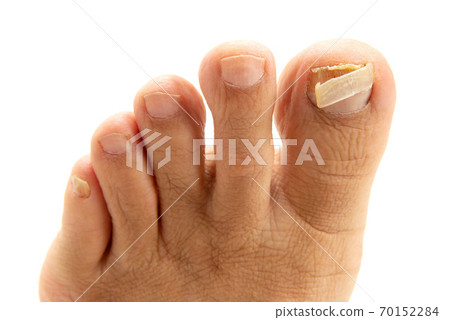 Toenail of a man's big toe cracked by... - Stock Photo [70152284] - PIXTA