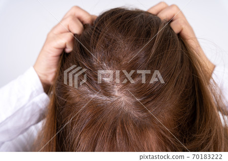 Close up woman head hair loss. Thinning hair on head. Healthcare medical or daily life concept. 70183222
