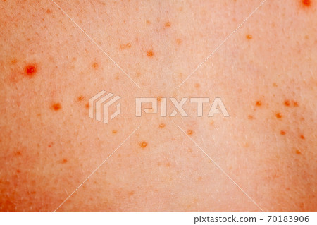 Close up image of a little boy's body suffering severe urticaria, nettle rash also called hives 70183906