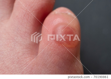 Callus on pinky toe after wearing uncomfortable shoes. Close up view. 70190861