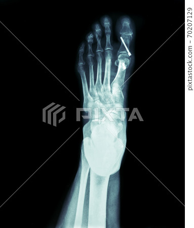 X-ray of the front foot Hallux Valgus surgery X-ray of the front foot Hallux Valgus surgery 70207129