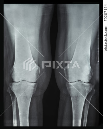 X-ray rheumatic diseases and knee Rheumatoid Arthritis 70207134