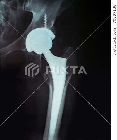 X-ray of the pelvis Endoprosthesis X-ray of the pelvis Endoprosthesis 70207136