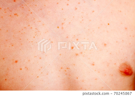 Close up image of a little boy's body suffering severe urticaria, nettle rash also called hives 70245867