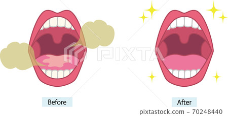 Bad breath before and after 70248440