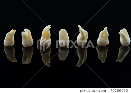 Seven removed diseased human teeth stacked in a row on black background. Close-up photo of spoiled molars and premolars. 70286950