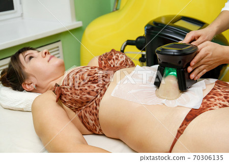 Woman getting cryolipolysis fat treatment on belly in beauty salon 70306135