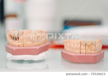 Dental layout of the human jaw with teeth and implants. Dental layout of the human jaw with teeth and implants. 70326623